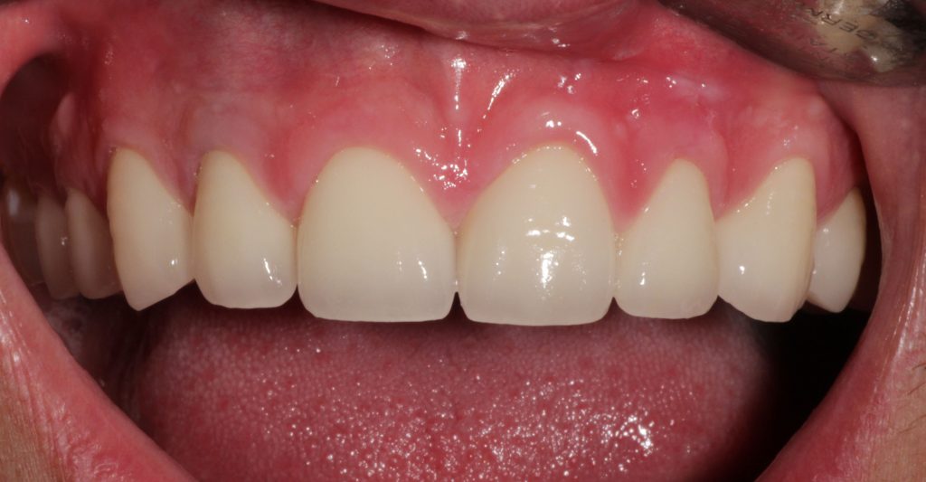 44afterdentaltreatment Pindan Dental Laboratory