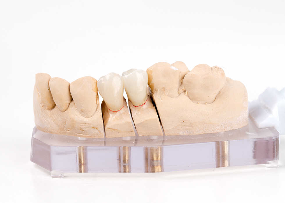 dental crown & bridges