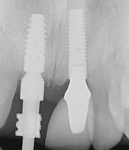 Post and core x-ray of teeth.