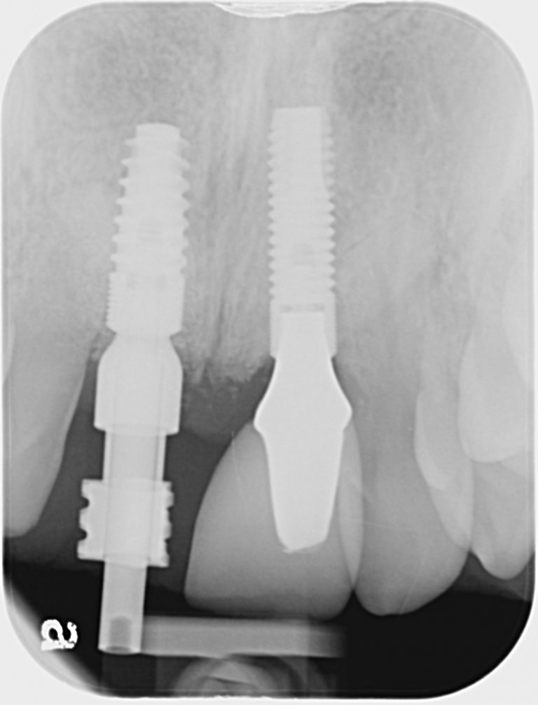 XRay Teeth Pindan Dental Laboratory
